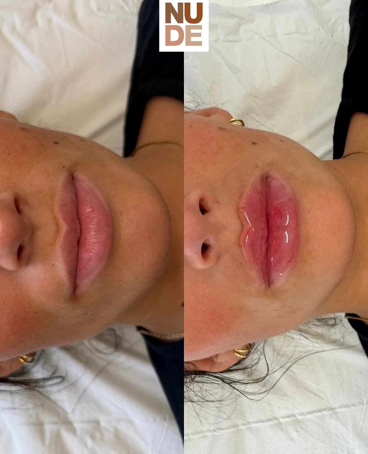 Lip Enhancement Results result 2