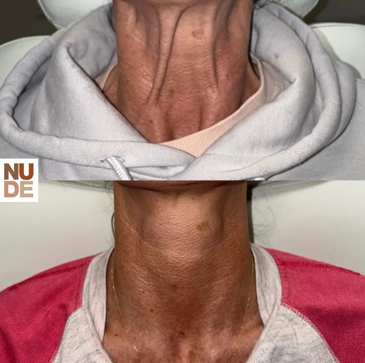 Nefertiti Facelift result 1