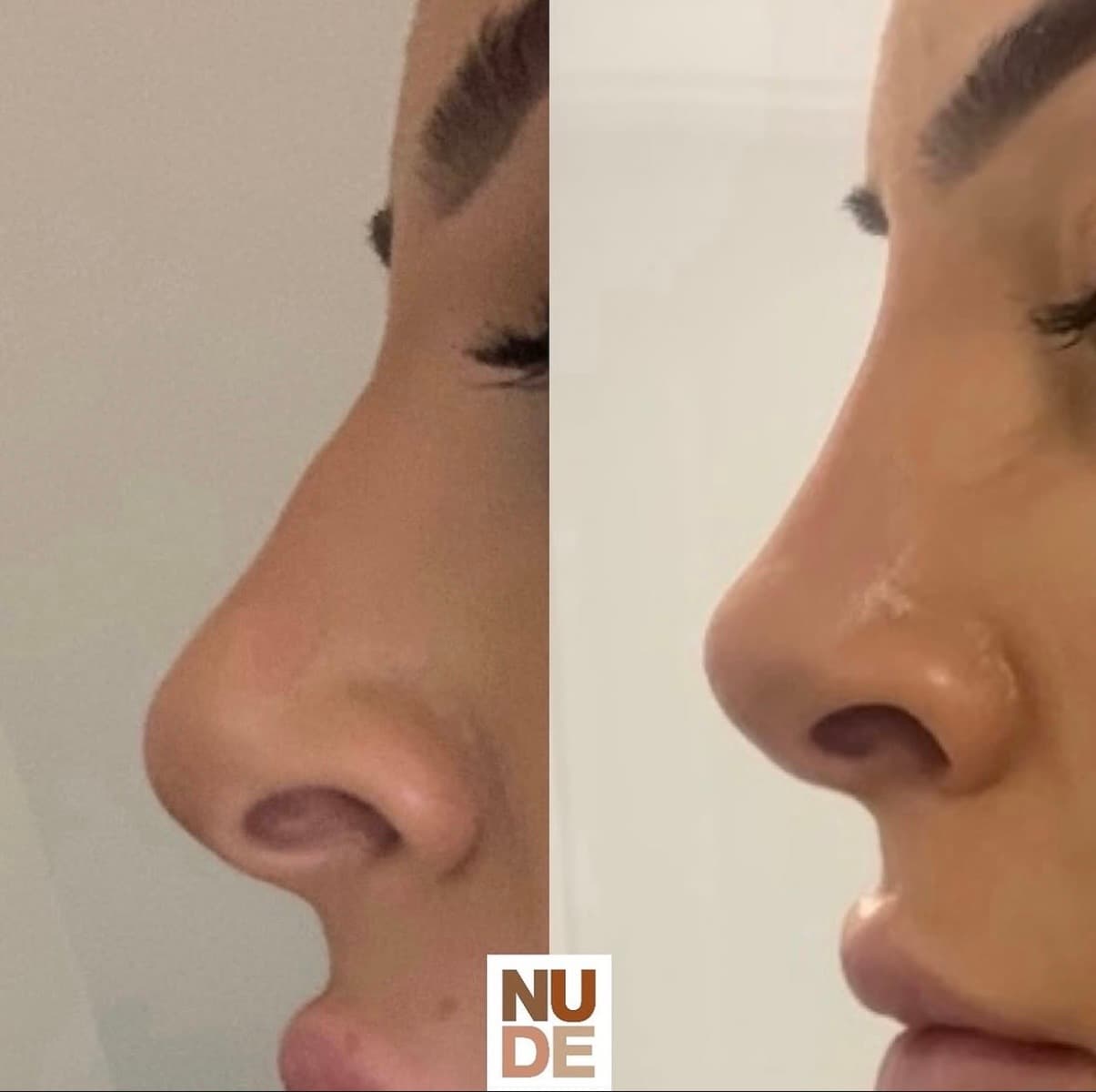 Non-Surgical Rhinoplasty result 1