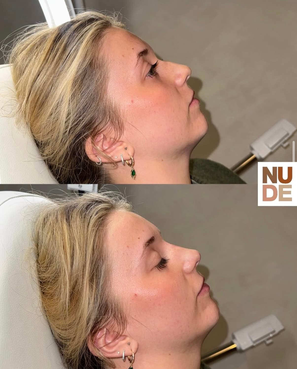 Non-Surgical Rhinoplasty result 2