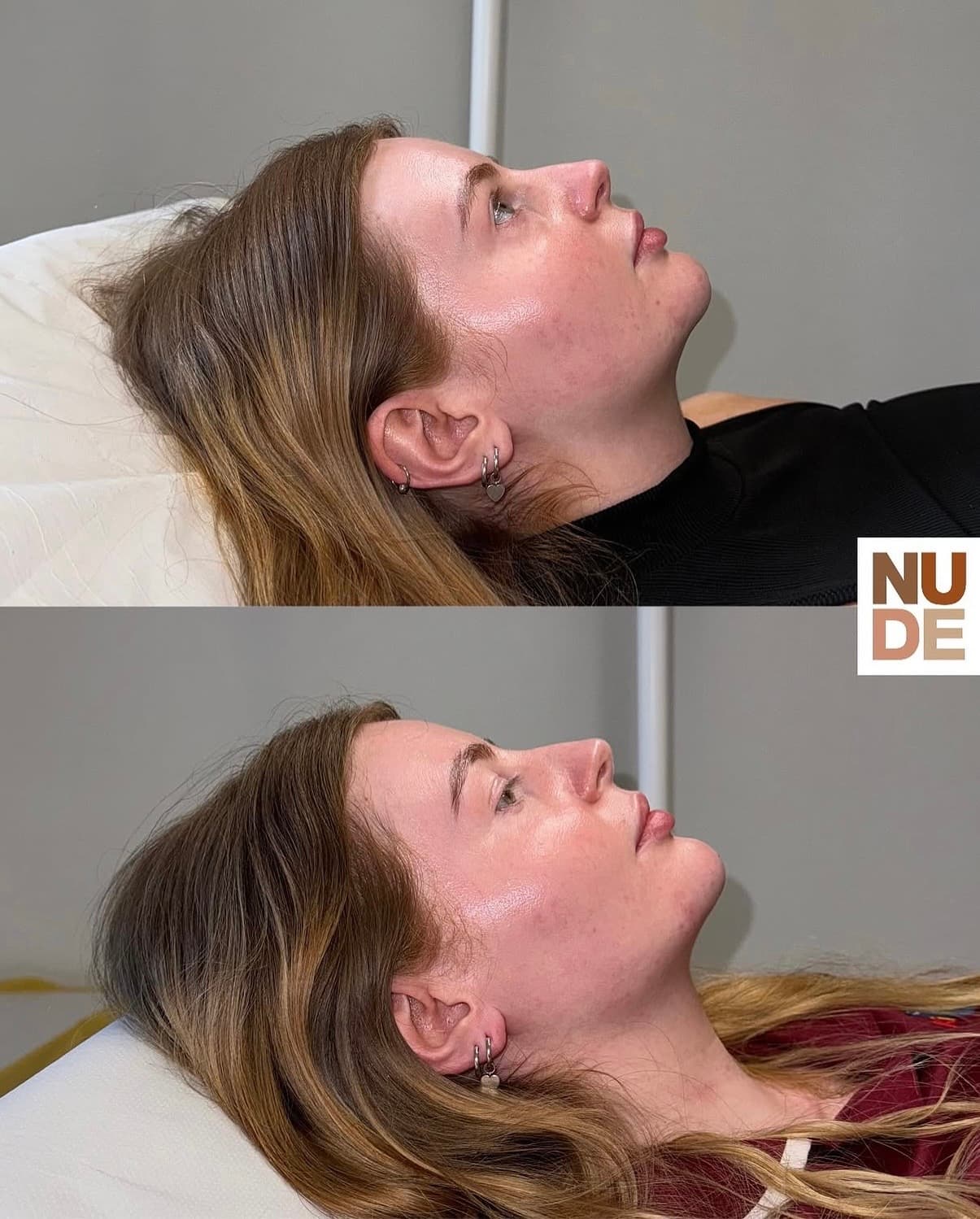 Dermal Filler result 1