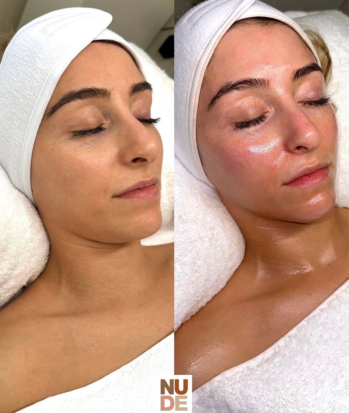 Polynucleotides & Skin Rejuvenation result 2